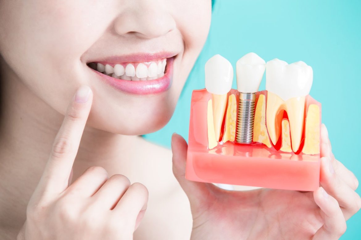 Thời điểm thích hợp cấy ghép implant